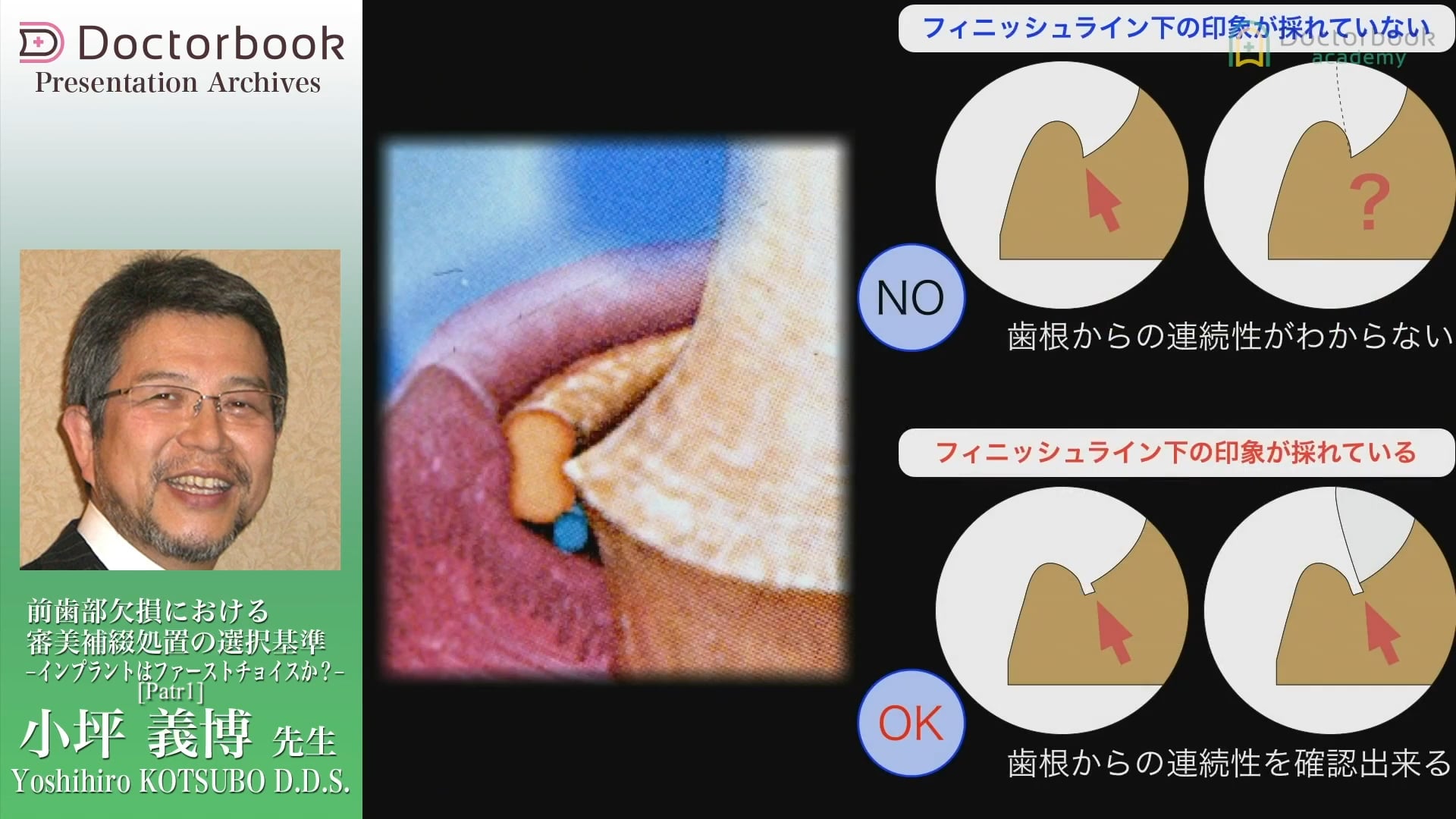 臨床知見録_審美補綴_印象の大切な部分