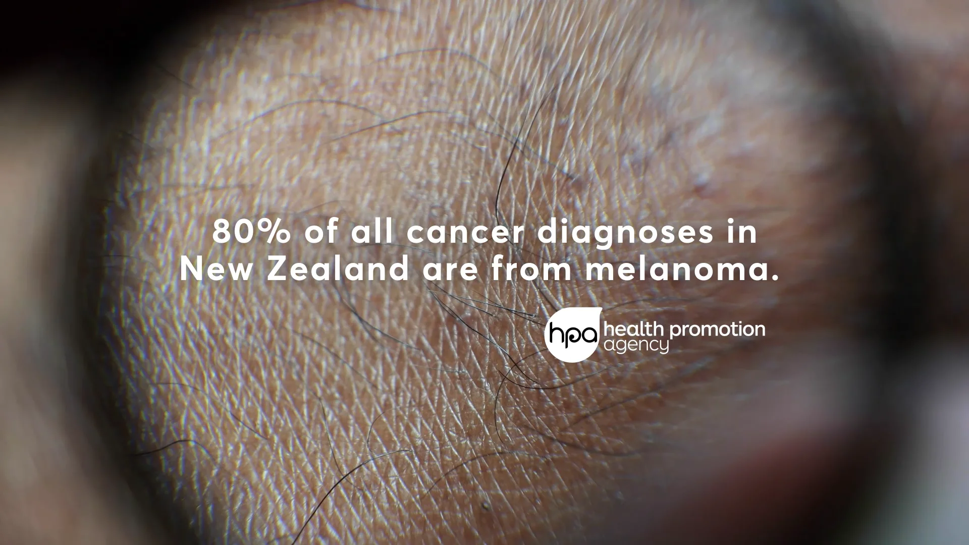 Melanoma Case study on Vimeo