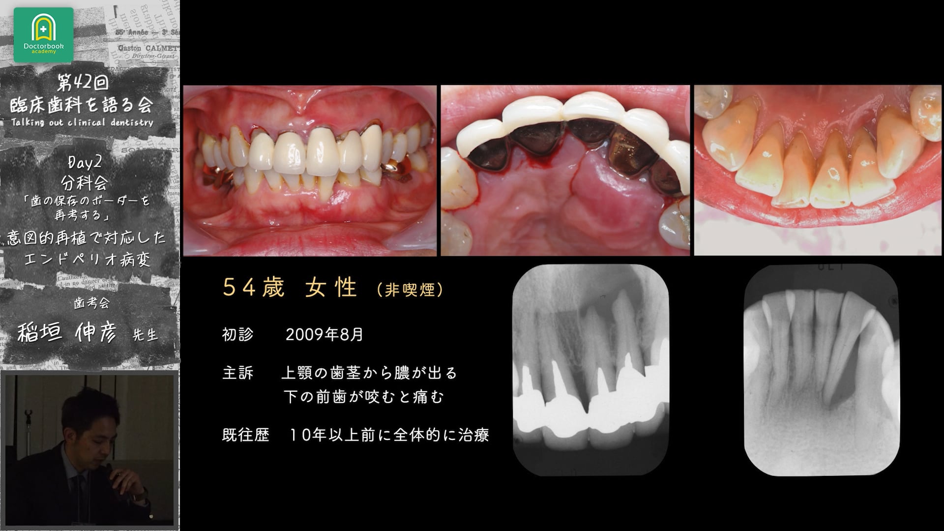 「意図的再植で対応したエンドペリオ病変」臨床歯科を語る会 分科会 歯の保存のボーダーを再考する #2　稲垣伸彦先生