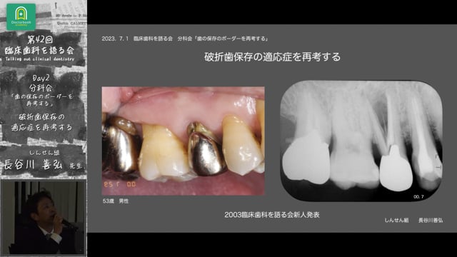「破折歯保存の適応症を再考する」臨床歯科を語る会 分科会 歯の保存のボーダーを再考する #3　長谷川善弘先生