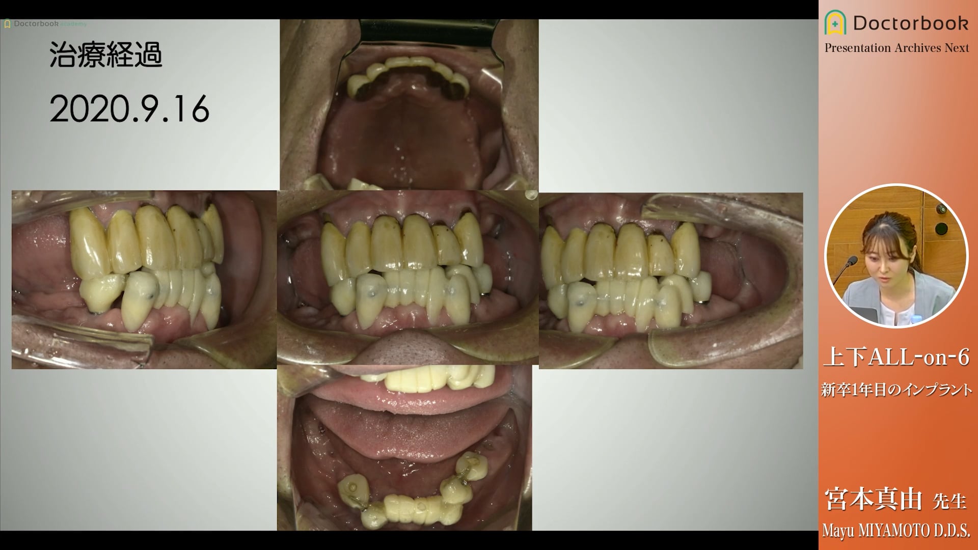 上下All-on-6 新卒1年目のインプラント