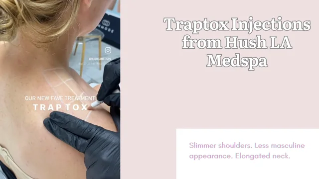 traps muscle tension relief botox｜TikTok Search