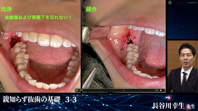 縫合で扱う器具・手技│完全版！埋伏抜歯のバイブル 3-3