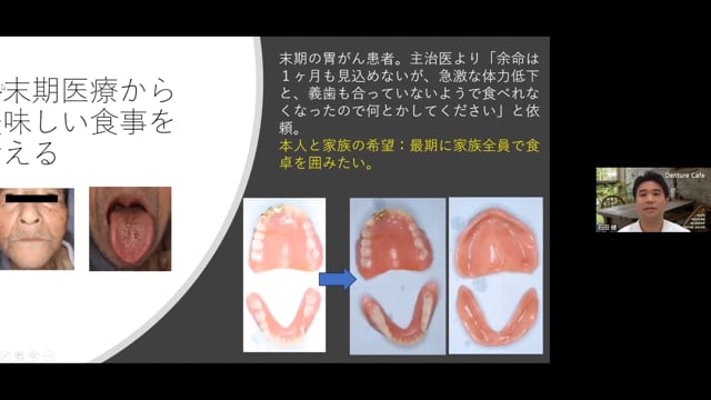 訪問診療における義歯治療のポテンシャル│石田 健先生
