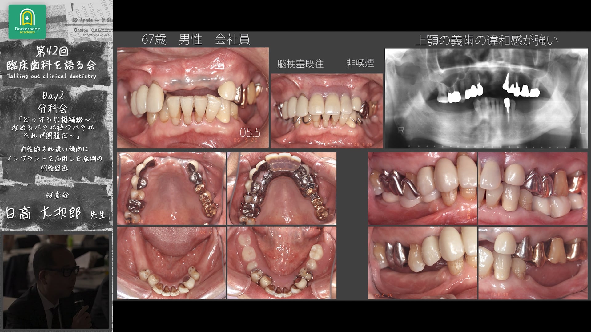 「前後的すれ違い傾向にインプラントを応用した症例の術後経過」臨床歯科を語る会 分科会 どうする欠損補綴～攻めるべきか待つべきか　それが問題だ～ #4　日高大次郎先生