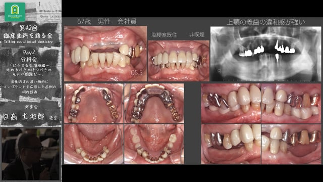 「前後的すれ違い傾向にインプラントを応用した症例の術後経過」臨床歯科を語る会 分科会 どうする欠損補綴～攻めるべきか待つべきか　それが問題だ～ #4　日高大次郎先生