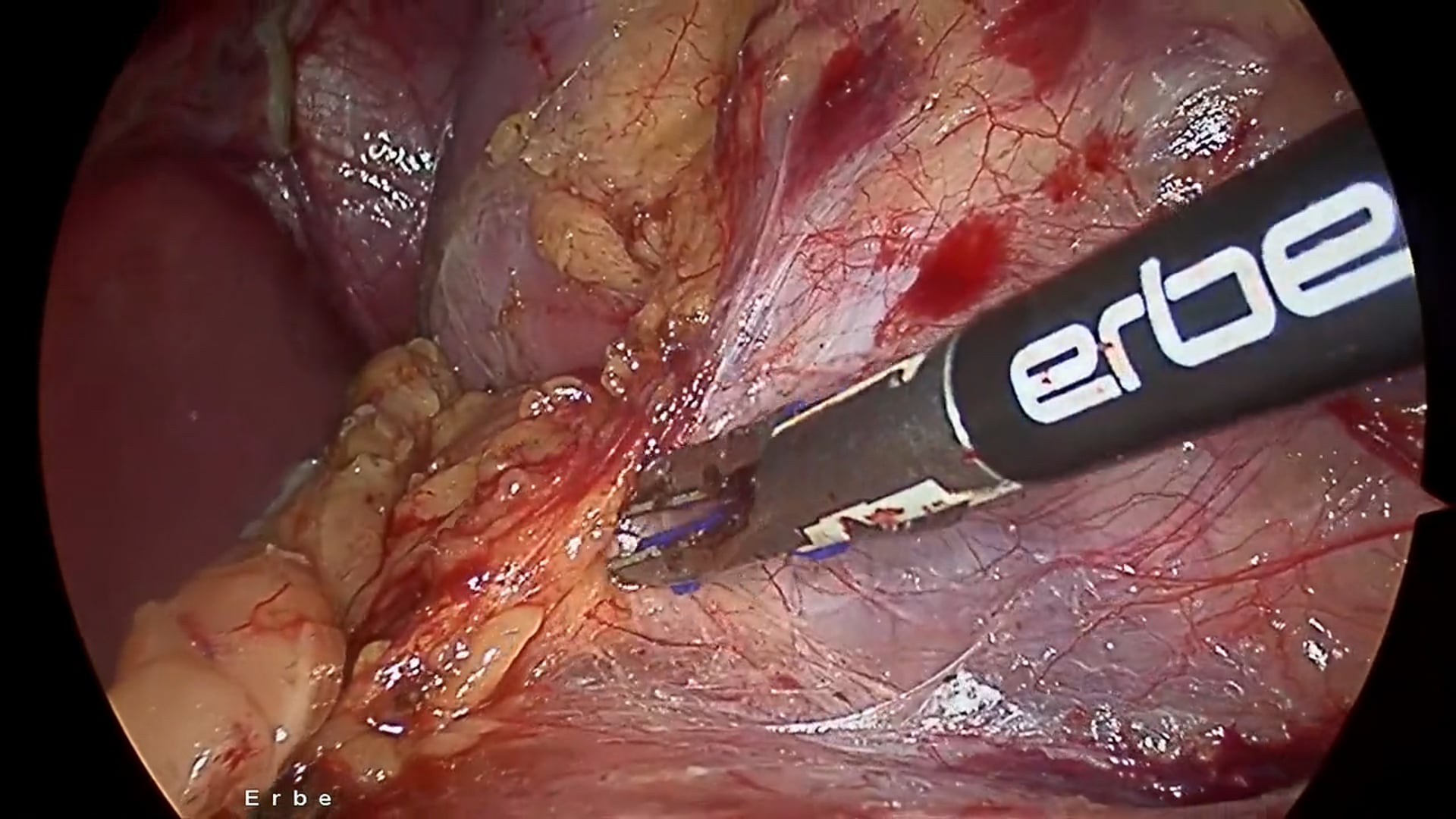 Laparoscopic living donor nephrectomy using TriSect rapide® and VIO® 3