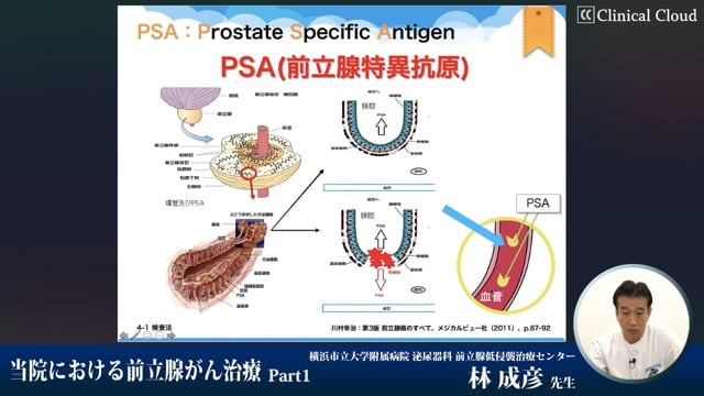 当院における前立腺がん治療　Part1