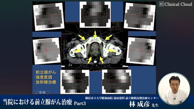 当院における前立腺がん治療　Part3