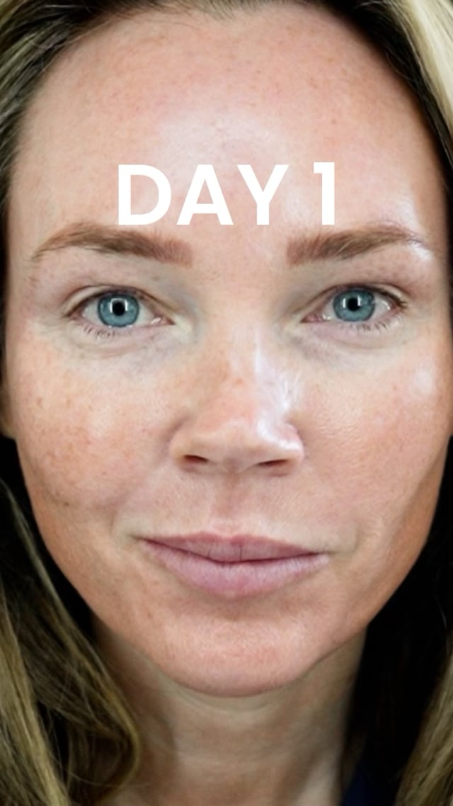 25% TCA Peel: Treatment Day video