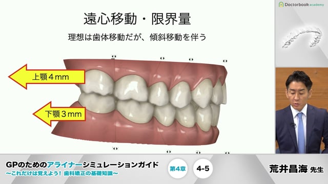 第4章 移動量と移動限界│GPのためのアライナーシミュレーションガイド 