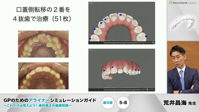 5-8 口蓋側転位の上顎2番