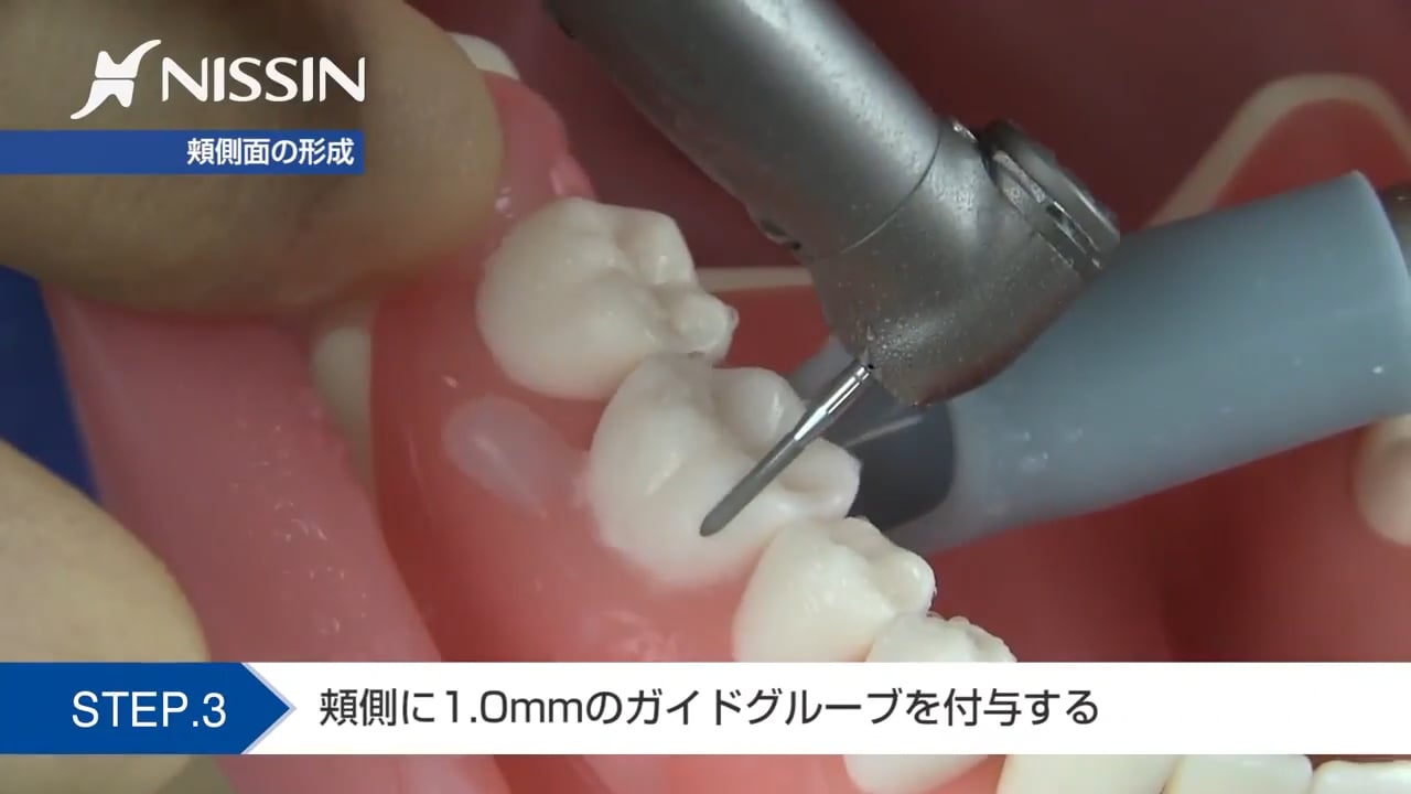 臨床知見録_支台歯形成_臼歯部メタルクラウンの形成