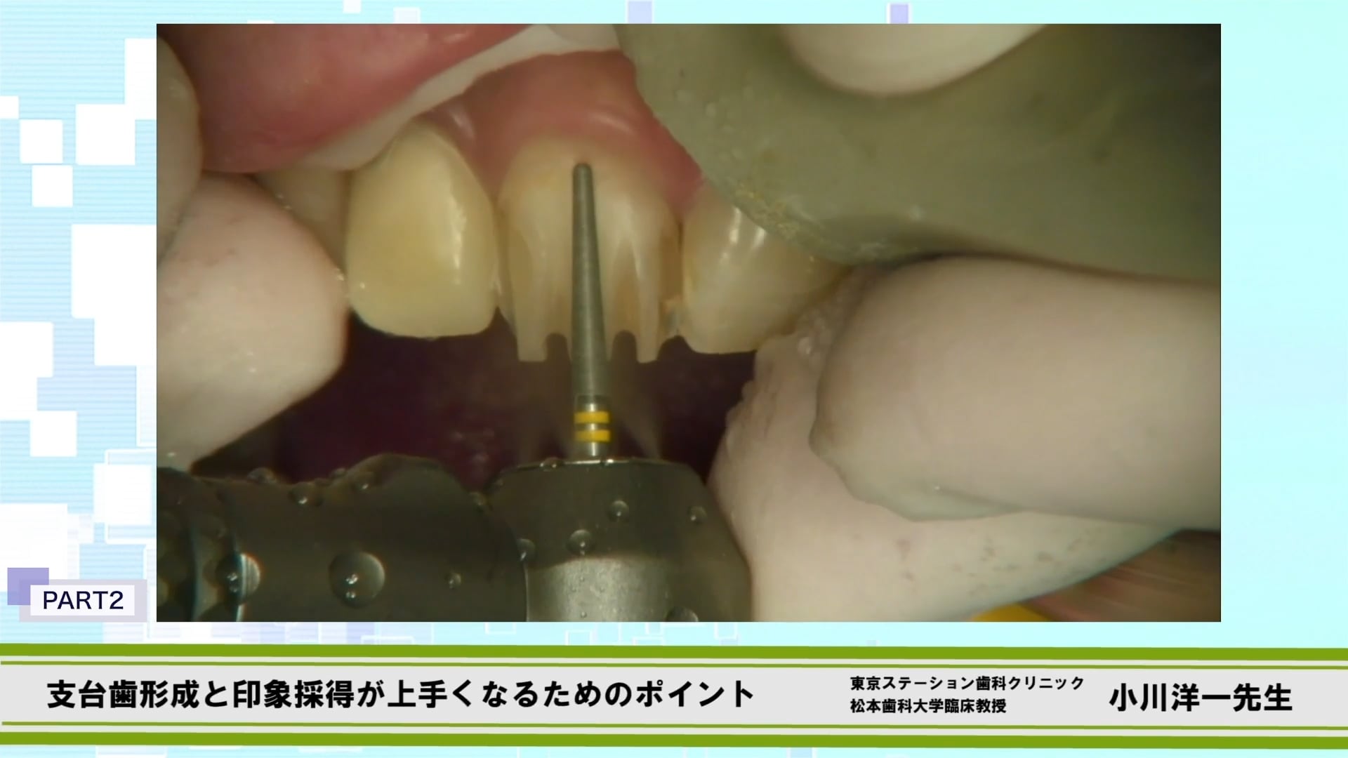 臨床知見録_支台歯形成_形成の実際