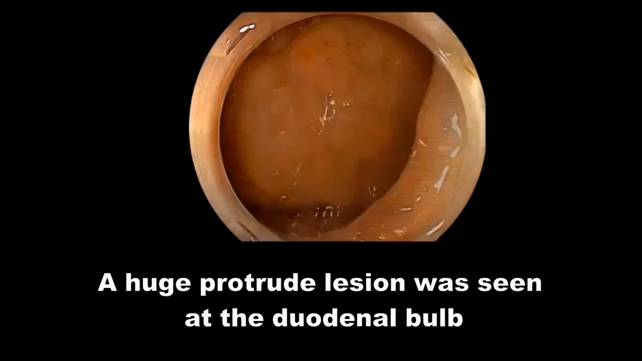 新版ESDアトラス 総論・食道・胃編 - 3-6-1-5)球部下壁Is+Ⅱa・球部内反転不可 TA-ESD・EndoTrac T type ...