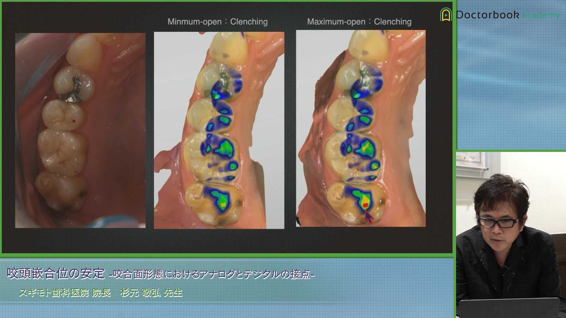 咬頭嵌合位の安定〜咬合面形態におけるアナログとデジタルの接点〜│杉元 敬弘先生 #4