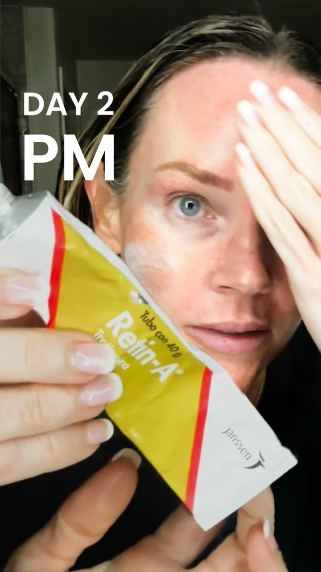 25% TCA Peel: Day 2 Evening video