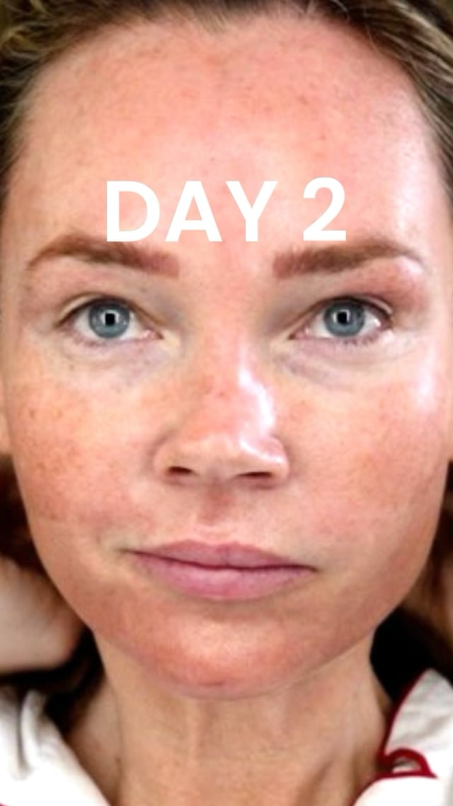 25% TCA Peel: Day 2 video