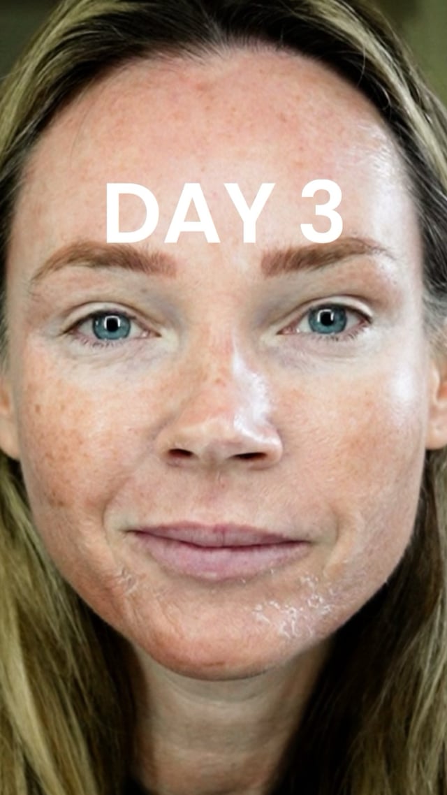 25% TCA Peel: Day 3 video