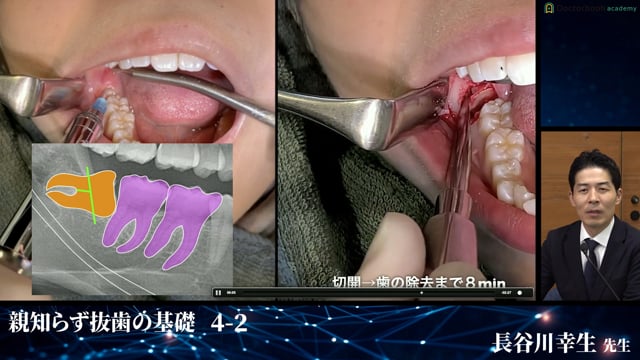 下顎水平埋伏智歯 歯冠の覗いている症例│親知らず抜歯の基礎 4-2