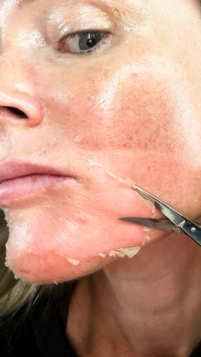 TCA Peel Recovery: Managing Loose Skin video