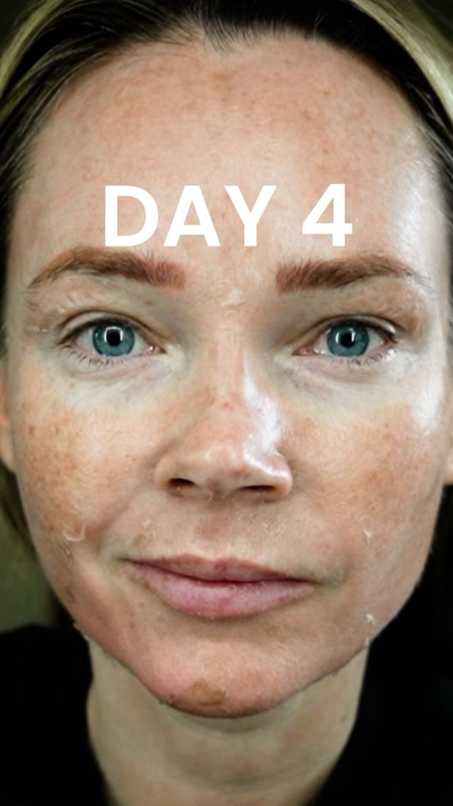 25% TCA Peel: Day 4 Progress video