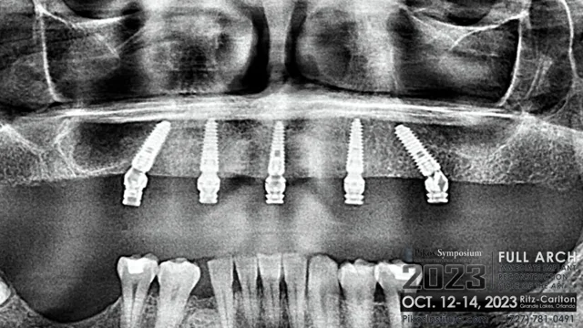 Keystone Dental Announces Market Launch of Nexus Connect, the First A.I.  Enabled Intraoral Implant-Scan Analyzer for the Nexus iOS Full-Arch  Solution