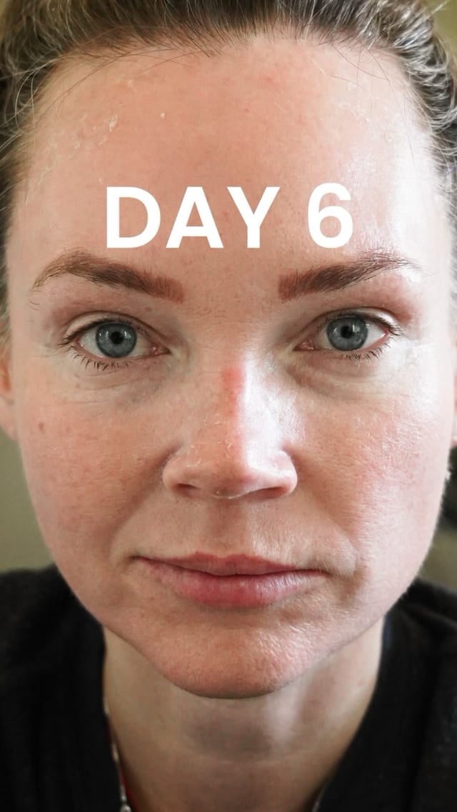 25% TCA Peel: Day 6 video