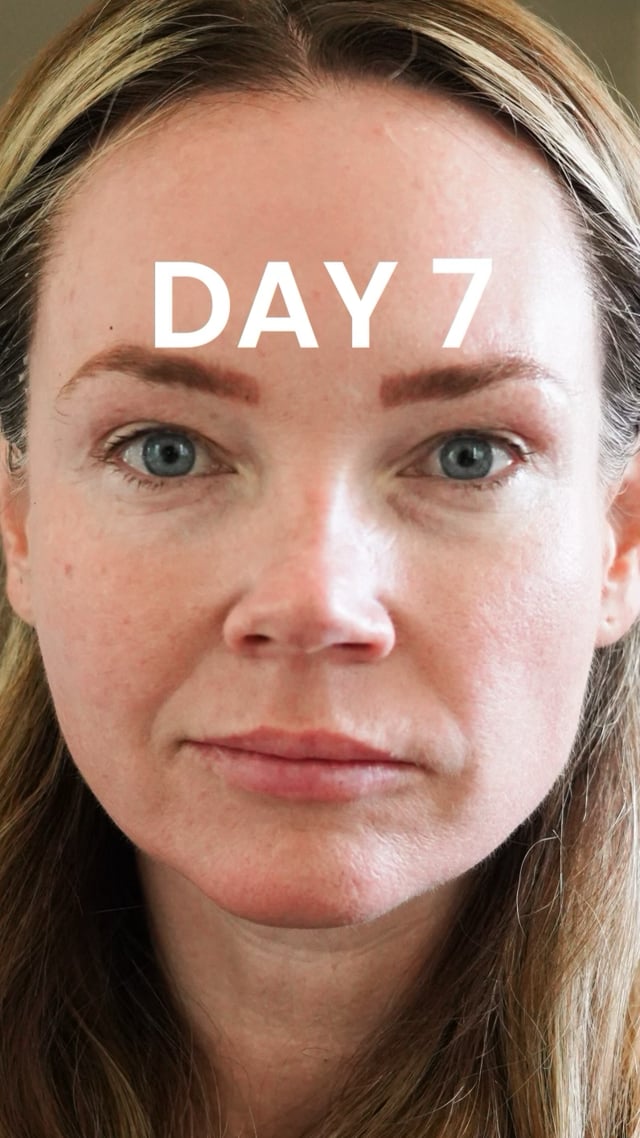 25% TCA Peel: Day 7 video