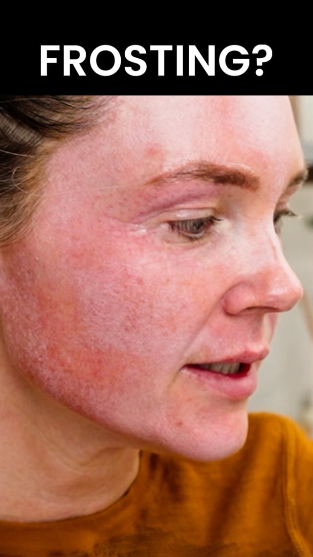 25% TCA Peel Frosting and One-Week Peel video