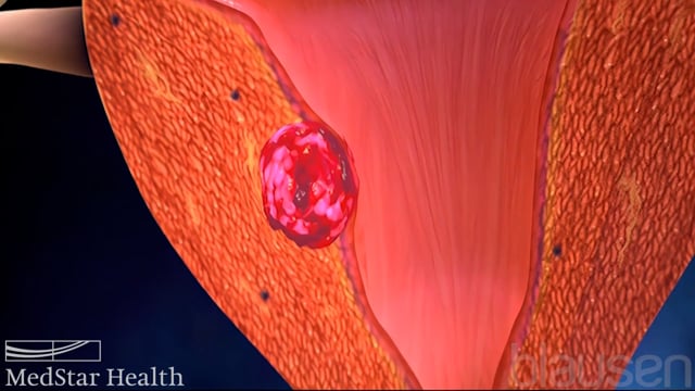 Cervical Cancer: Causes, symptoms, myths & facts & more