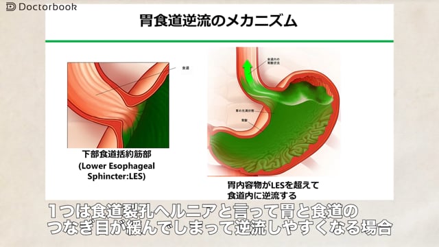 胃食道逆流症を引き起こす要因と治療薬