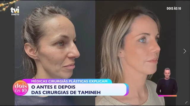 Lifting Facial Com Fios - Dra. Paula Gomes - Medicina Estética