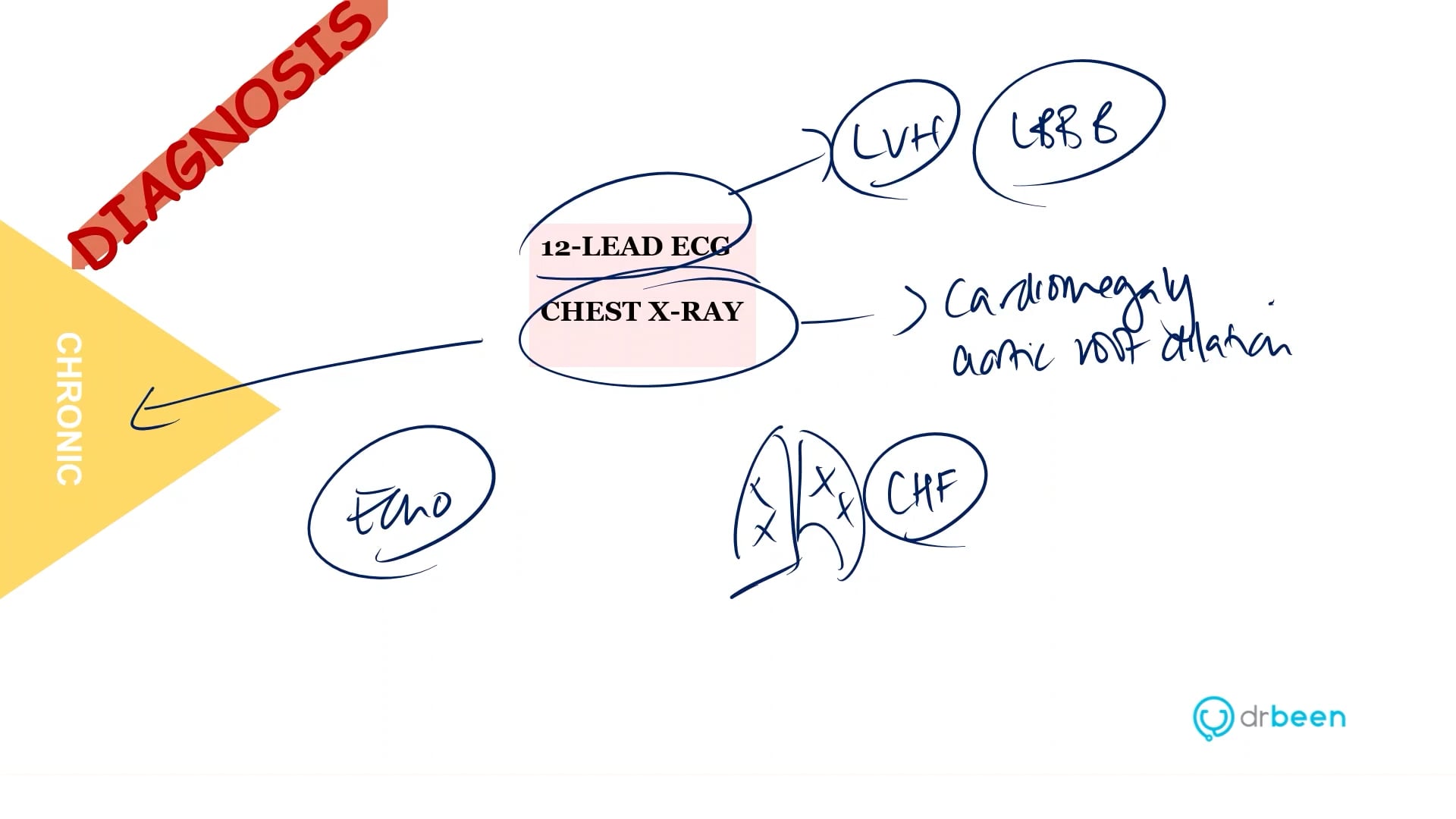 Aortic Regurgitation (Dr. Bhatti)