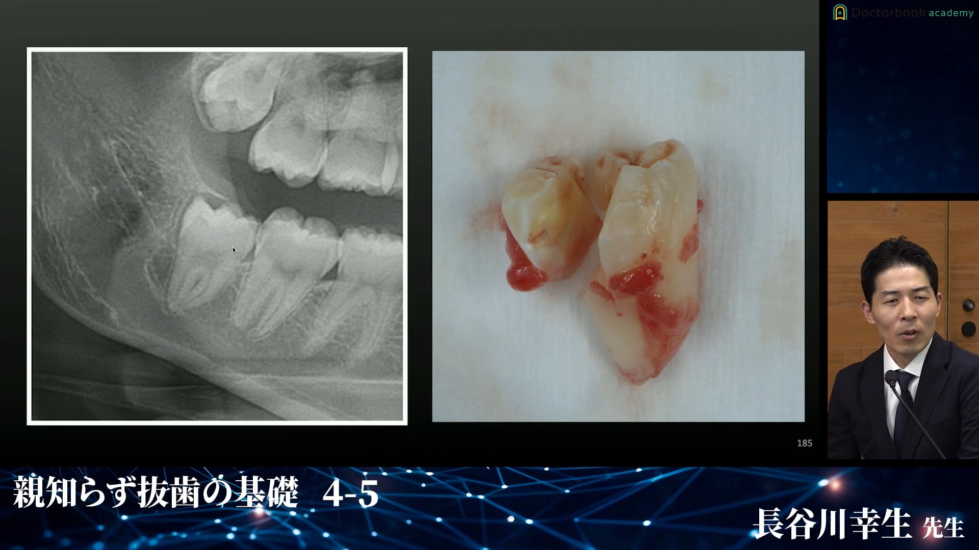 下顎垂直埋伏智歯の症例│親知らず抜歯の基礎 4-5