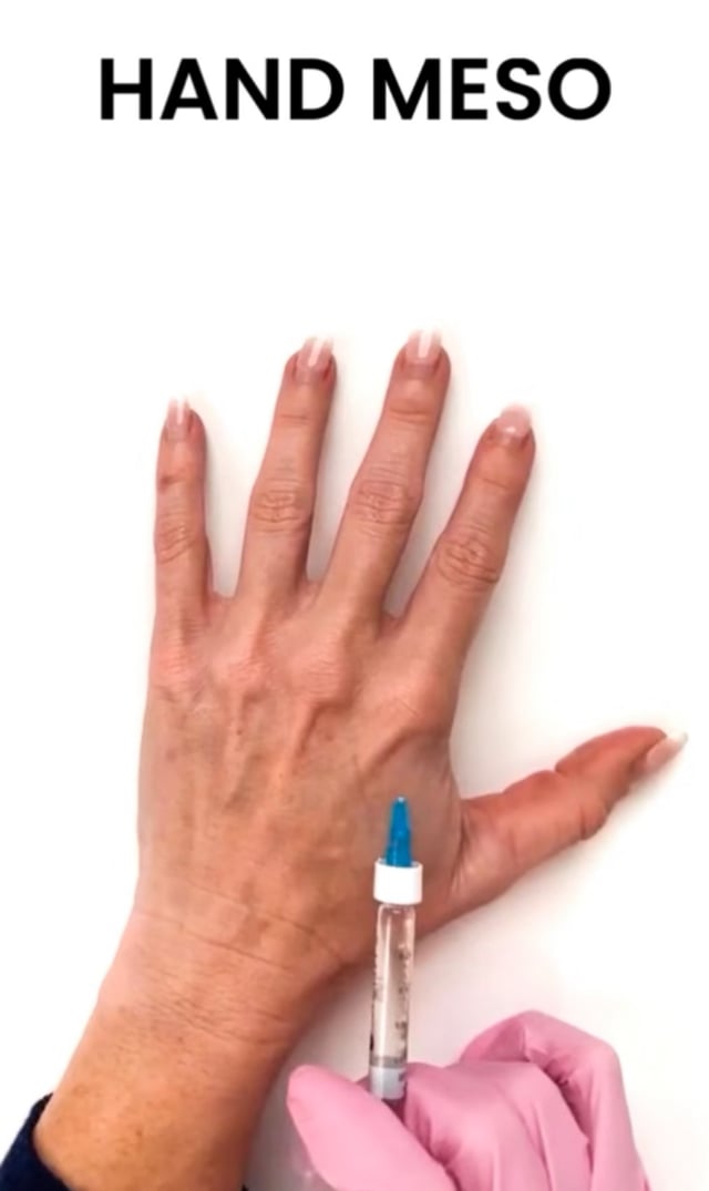 Hand Mesotherapy Progress video