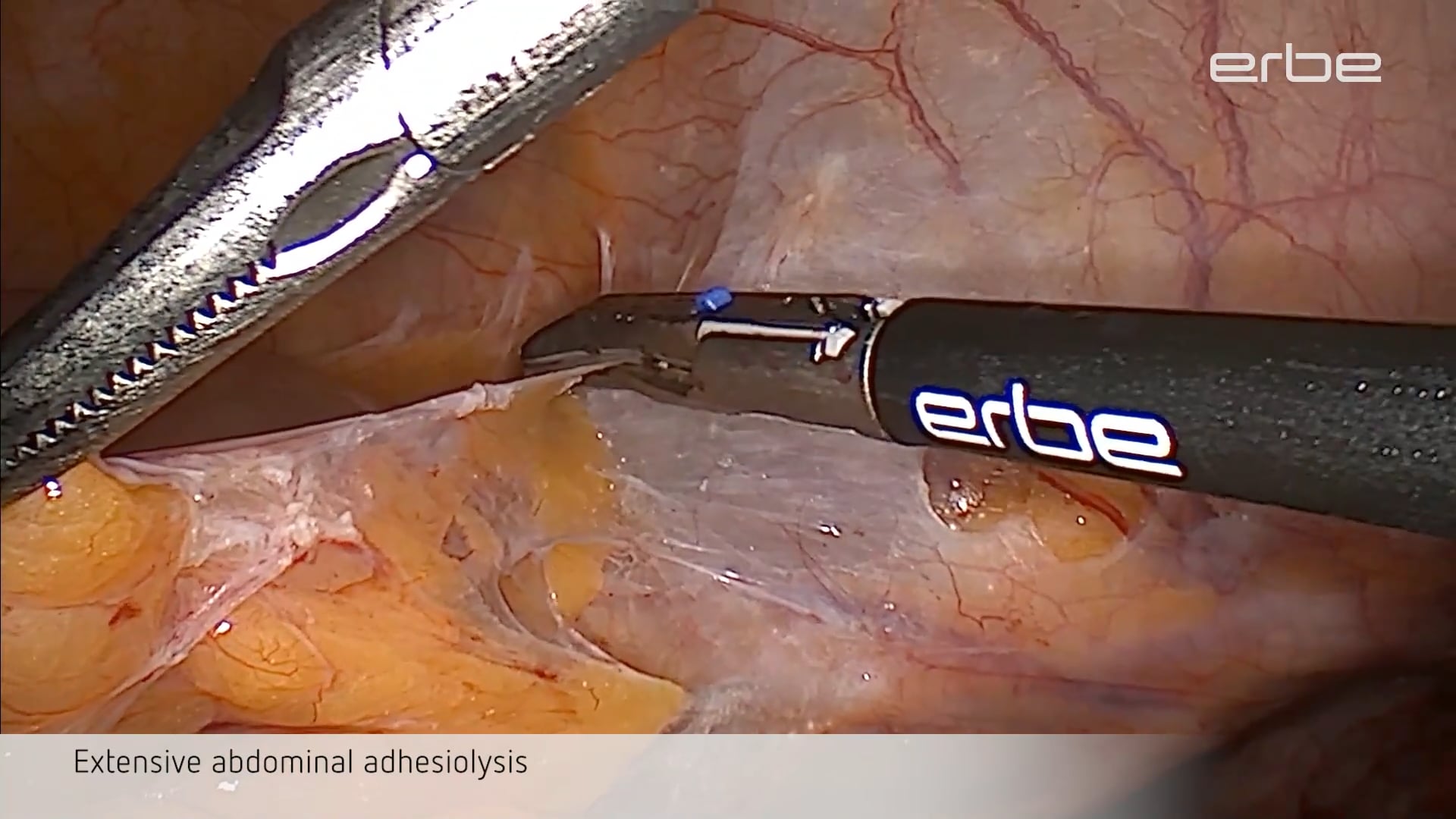 Electrosurgical adhesiolysis and dissection of endometriotic lesions in case of DIE using TriSect rapide®