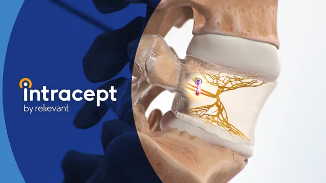 Back Pain Releif with Implantable Devices State of the Art