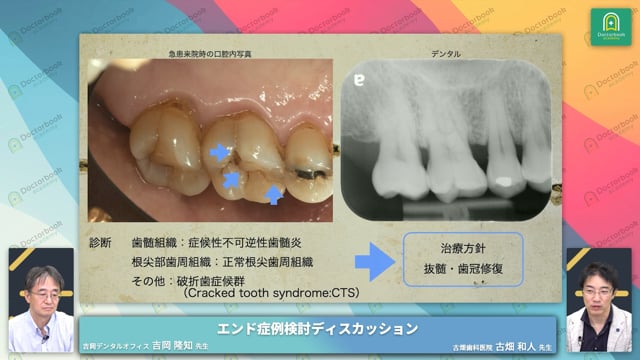 右上第一大臼歯にエナメルクラックが見られる症例│破折歯症候群（CTS）を起こしやすい人の特徴と部位について