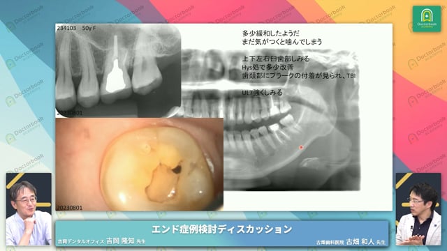50代女性 左下第一大臼歯のCTS症例│破折歯症候群（CTS）に見られる口腔内所見と治療法