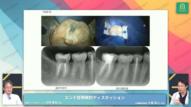 CTSにより右下第二大臼歯を抜髄した2症例│メインテナンス時における破折歯症候群(CTS)を強く疑うべきポイント