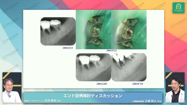 左下第一大臼歯クラックラインと歯肉辺縁の腫脹│左下第一大臼歯 骨吸収症例