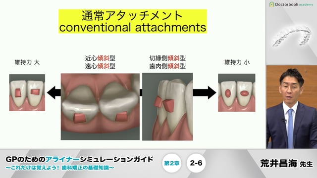 第2章 インビザラインのアライナーの特徴│GPのためのアライナー