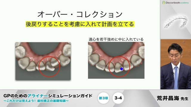 アライナー矯正治療 診断 治療計画 矯正治療 顎位整復治療 - 健康・医学