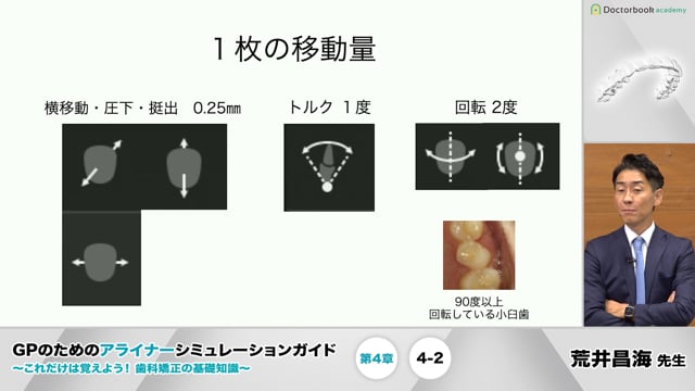 第4章 移動量と移動限界│GPのためのアライナーシミュレーションガイド