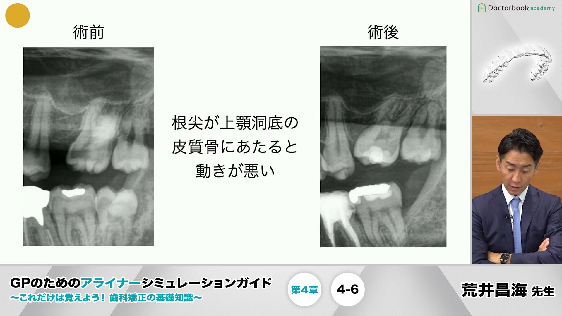 4-6 近心移動