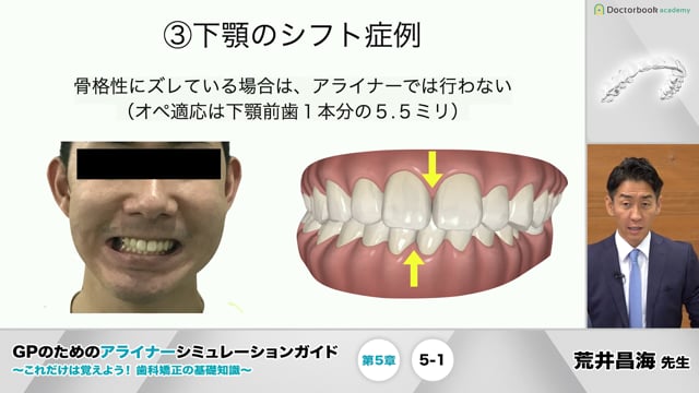 新品即決 アライナー シミュレーション ガイド インビザライン 健康 