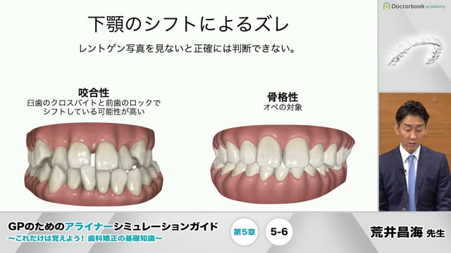 第5章 症例ごとの治療計画│GPのためのアライナーシミュレーション 