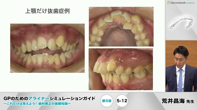 5-12 抜歯症例