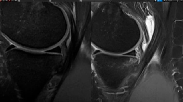 quick tip - ramp lesion or not